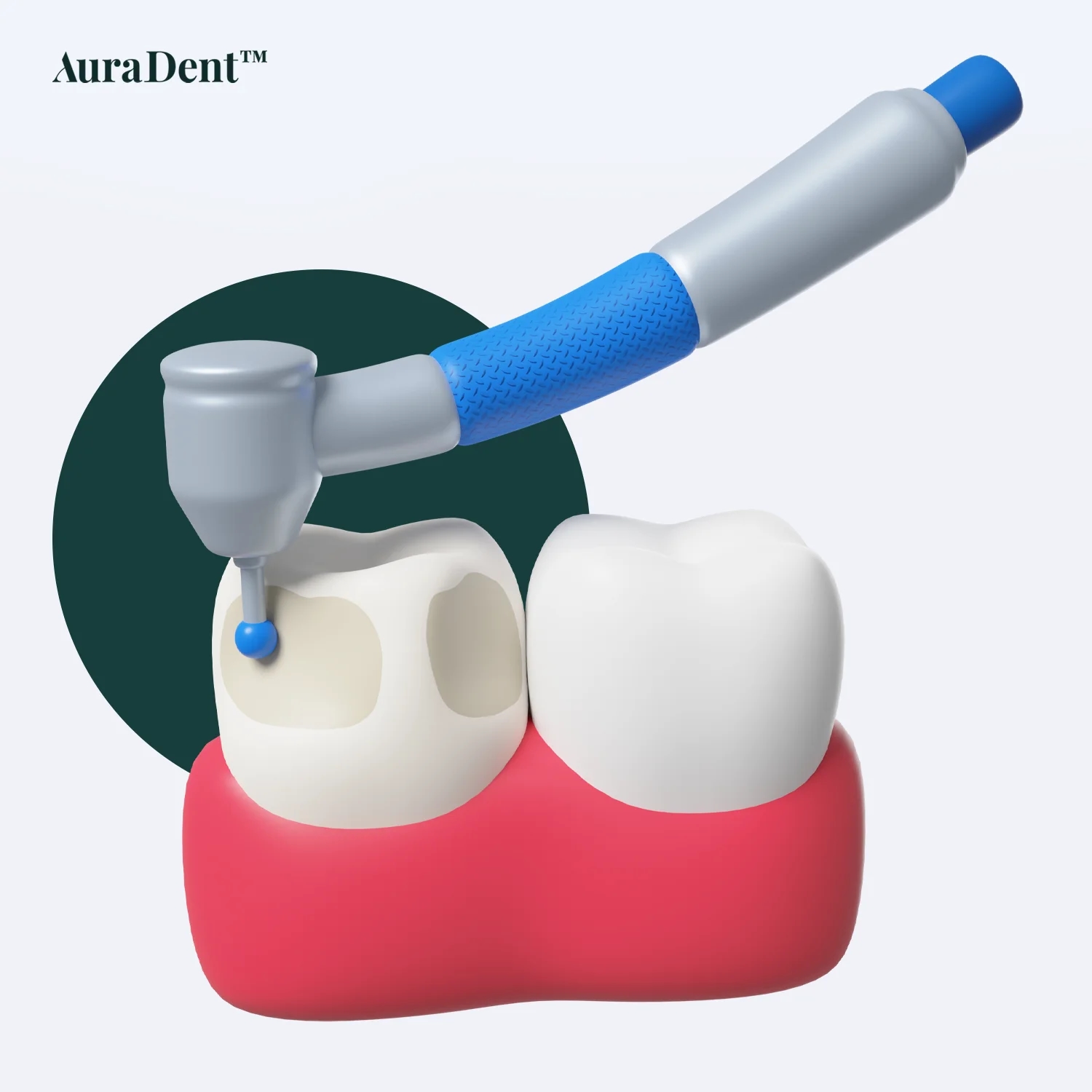 Kariesbehandling: Kostnad, Typer av Fyllningar och Guide 2025