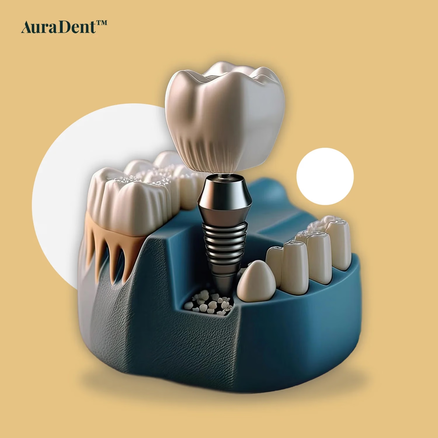 Misslyckade tandimplantat: den kompletta guiden till orsaker, tecken och behandling