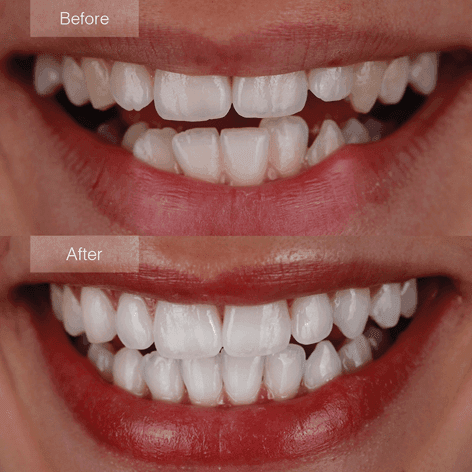 Invisalign före och efter