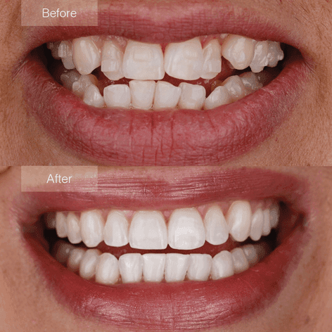 Invisalign före och efter
