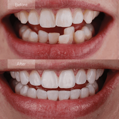 Invisalign före och efter