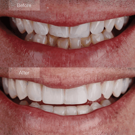 Invisalign före och efter