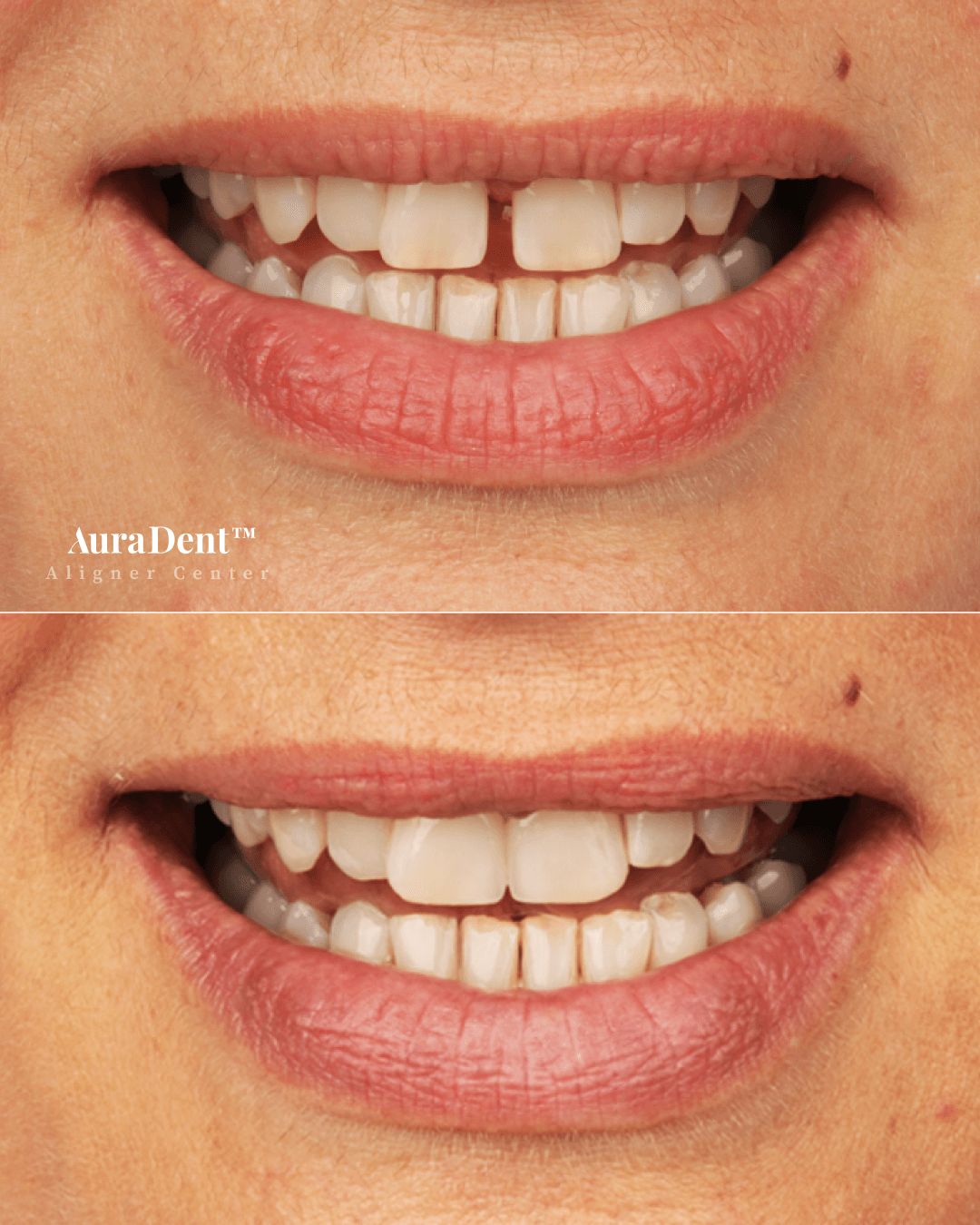 Venners före och efter