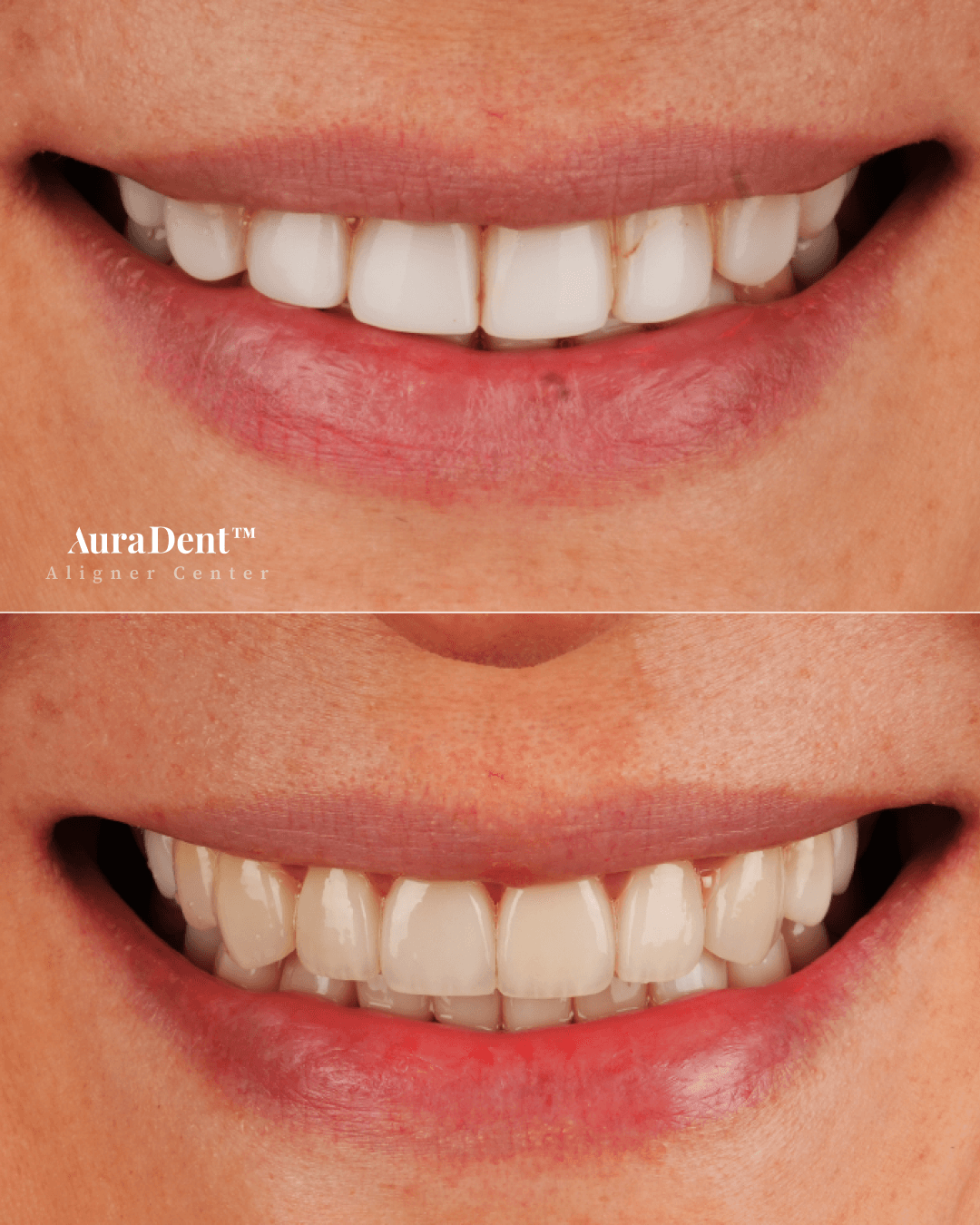 Venners före och efter