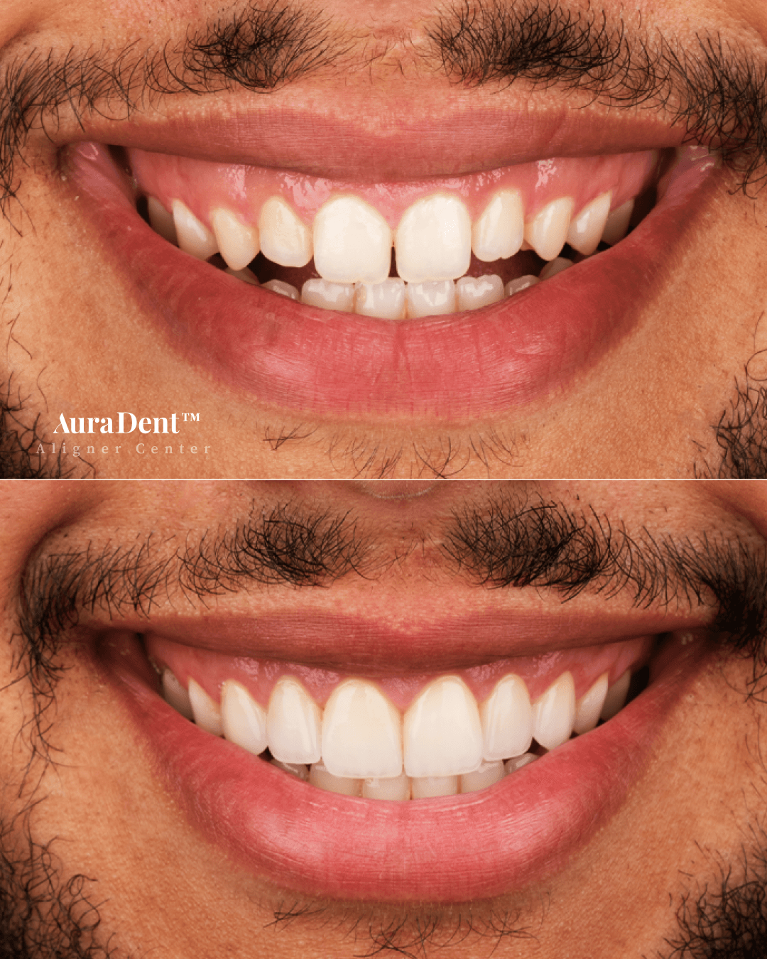 Venners före och efter