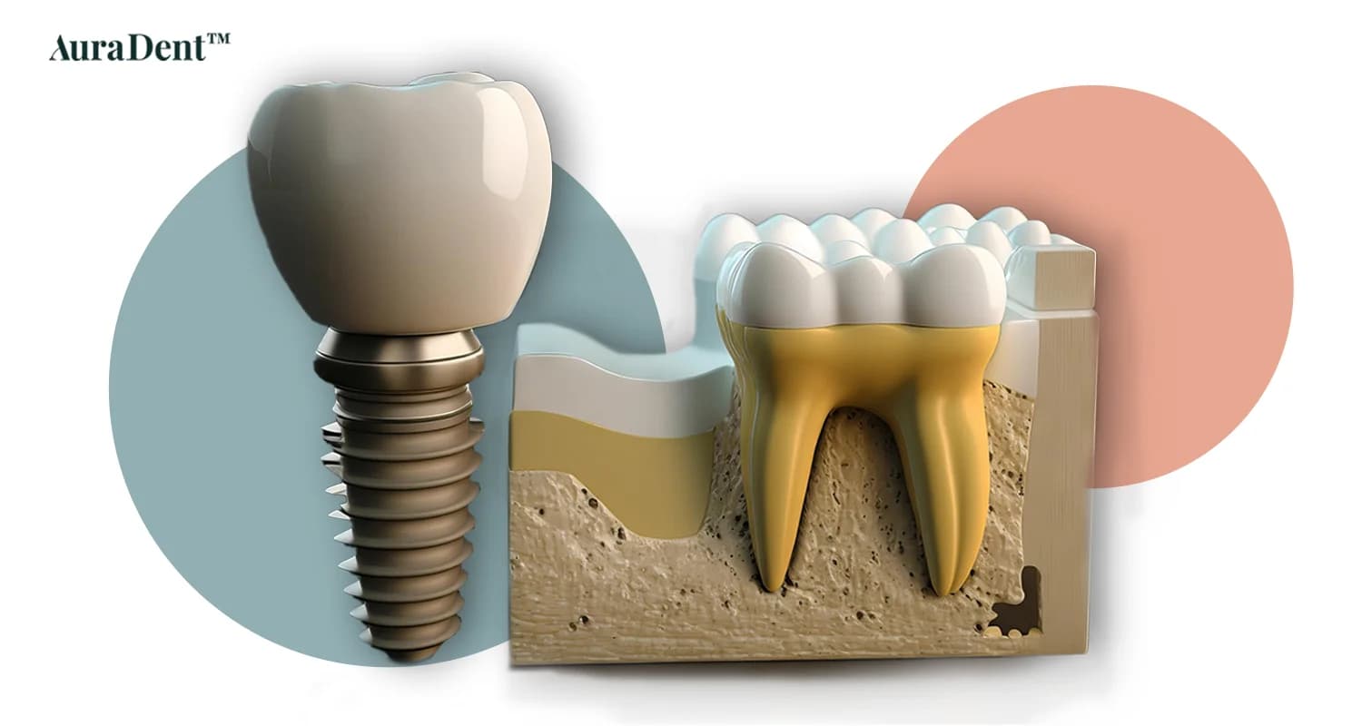 Detta foto visar en 3d-målning av ett tandimplantat bredvid en naturlig tand