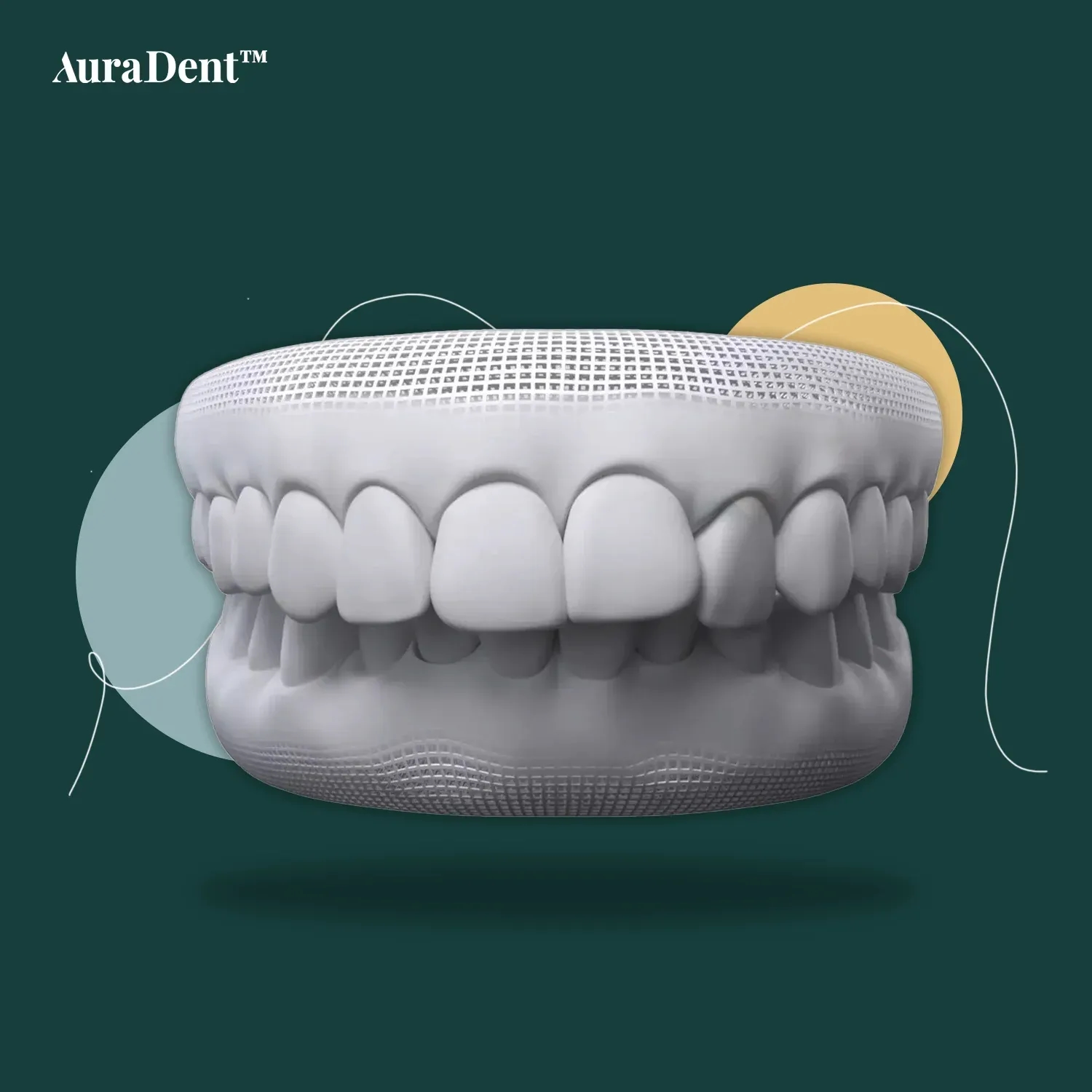 How Long Do You Wear Braces for Overbite
