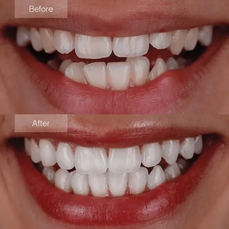 Invisalign-before-after